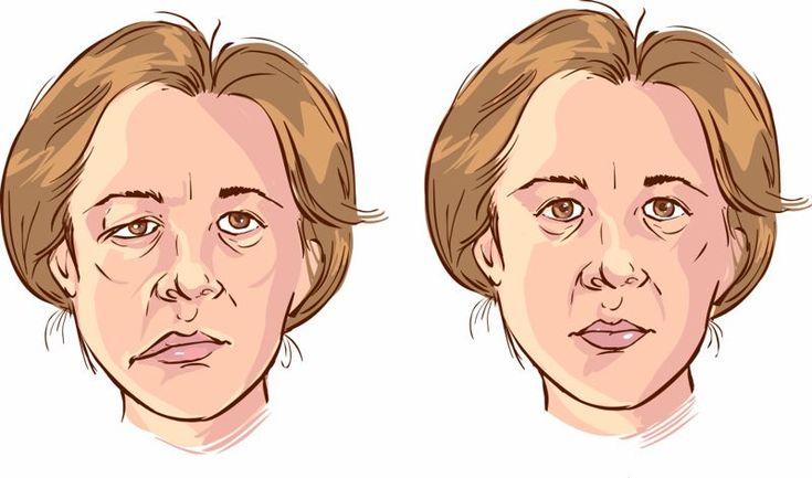 Mengetahui Kondisi Bell's Palsy Serta Gejalanya