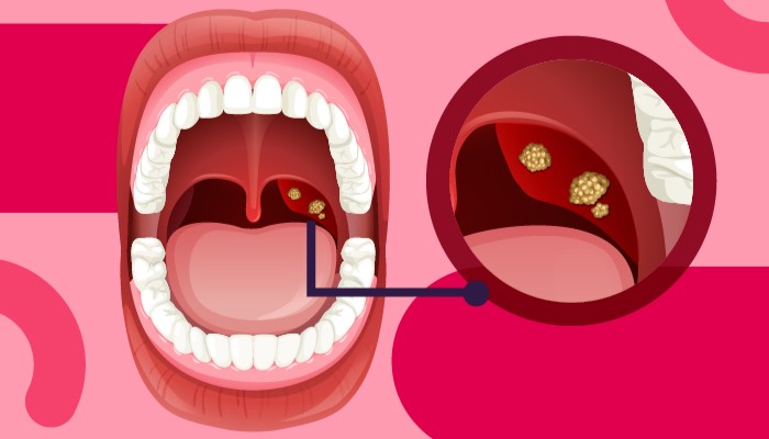 Batu Amandel Menyebabkan Bau Mulut, Kenali Gejalanya!