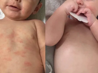 Kulit Iritasi Pada Bayi: Apa Penyebab Dan Cara Mengobatinya