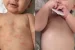 Kulit Iritasi Pada Bayi: Apa Penyebab Dan Cara Mengobatinya