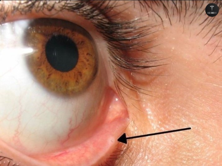 Lacrimal Punctum