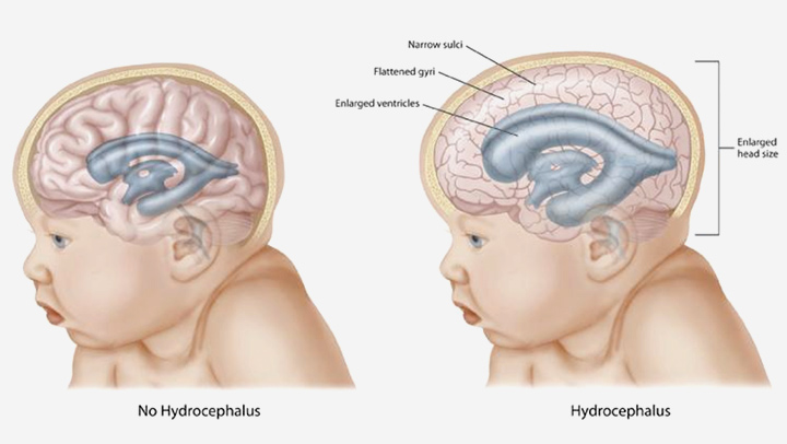 Penyakit Hidrosefalus Umum Terjadi Pada Bayi Baru lahir