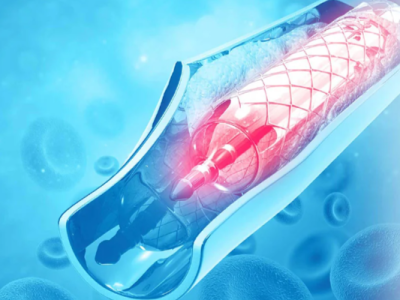 Pemasangan Stent Sangat Bermanfaat Untuk Pengobatan Jantung