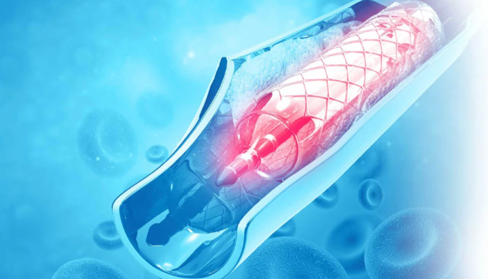 Pemasangan Stent Sangat Bermanfaat Untuk Pengobatan Jantung