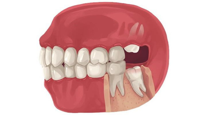 Impaksi Gigi Bungsu Yang Kerap Kali Harus Di Cabut