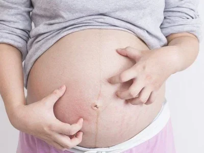 Selulit Atau Stretch Mark Sering Terjadi Pada Ibu Hamil