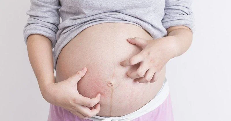 Selulit Atau Stretch Mark Sering Terjadi Pada Ibu Hamil