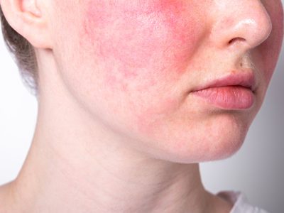 Menjelaskan Tentang Kulit Menjadi Berwarna Merah