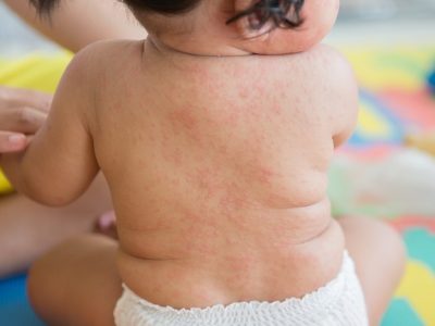 Ruam Panas Bayi: Gejala, Pencegahan & Pengobatan,