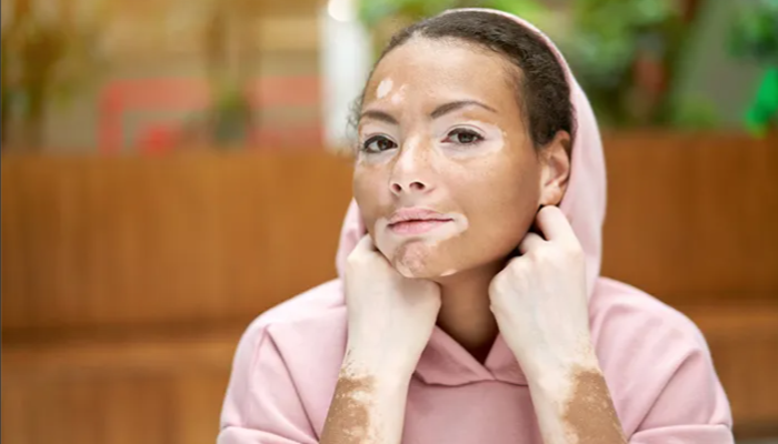 Vitiligo Ternyata Memiliki Dua Subjenis, Kenali Yuk!