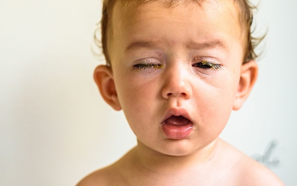 Mata Belekan Setelah Batuk Dan Demam, Wajar atau Bahaya?