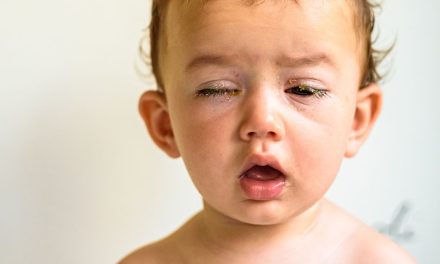 Mata Belekan Setelah Batuk Dan Demam, Wajar atau Bahaya?