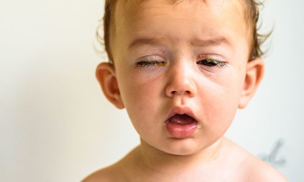 Mata Belekan Setelah Batuk Dan Demam, Wajar atau Bahaya?