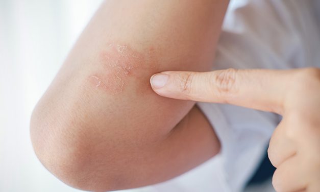 Munculnya Jamur Kulit Bikin Terasa Gatal Yang Gak Nyaman