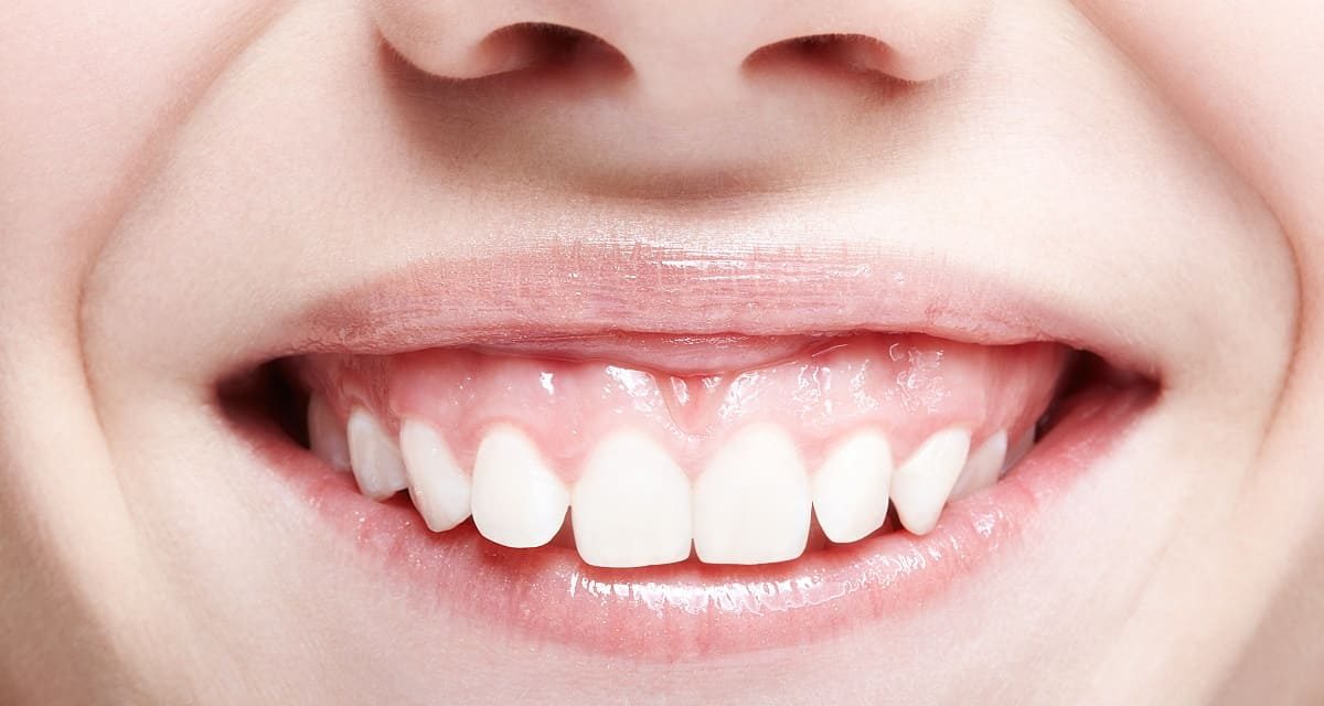 Gummy Smile Benarkah Keberadaannya Menganggu Penampilan