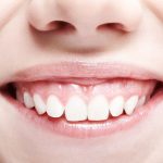Gummy Smile Benarkah Keberadaannya Menganggu Penampilan