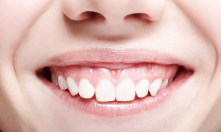 Gummy Smile Benarkah Keberadaannya Menganggu Penampilan