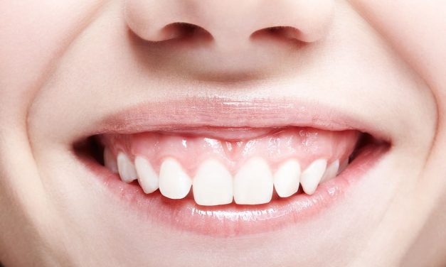 Gummy Smile Benarkah Keberadaannya Menganggu Penampilan