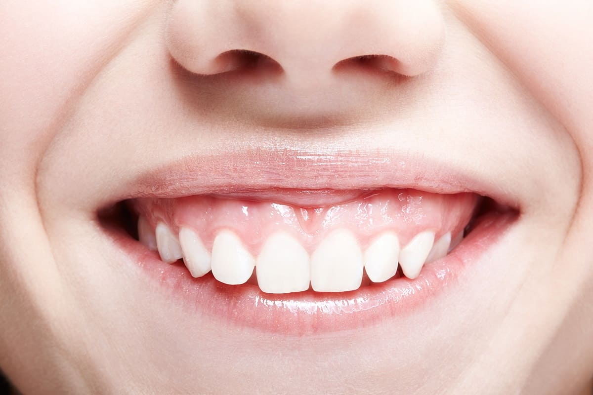 Gummy Smile